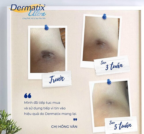Kem trị sẹo Dermatix Ultra giúp loại bỏ mọi loại sẹo dễ dàng, nhanh chóng